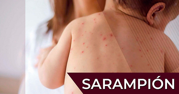 UNAM: Sarampión, más contagioso que la COVID-19; evitar automedicarse